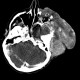 Hemangioma of face, extensive: CT - Computed tomography
